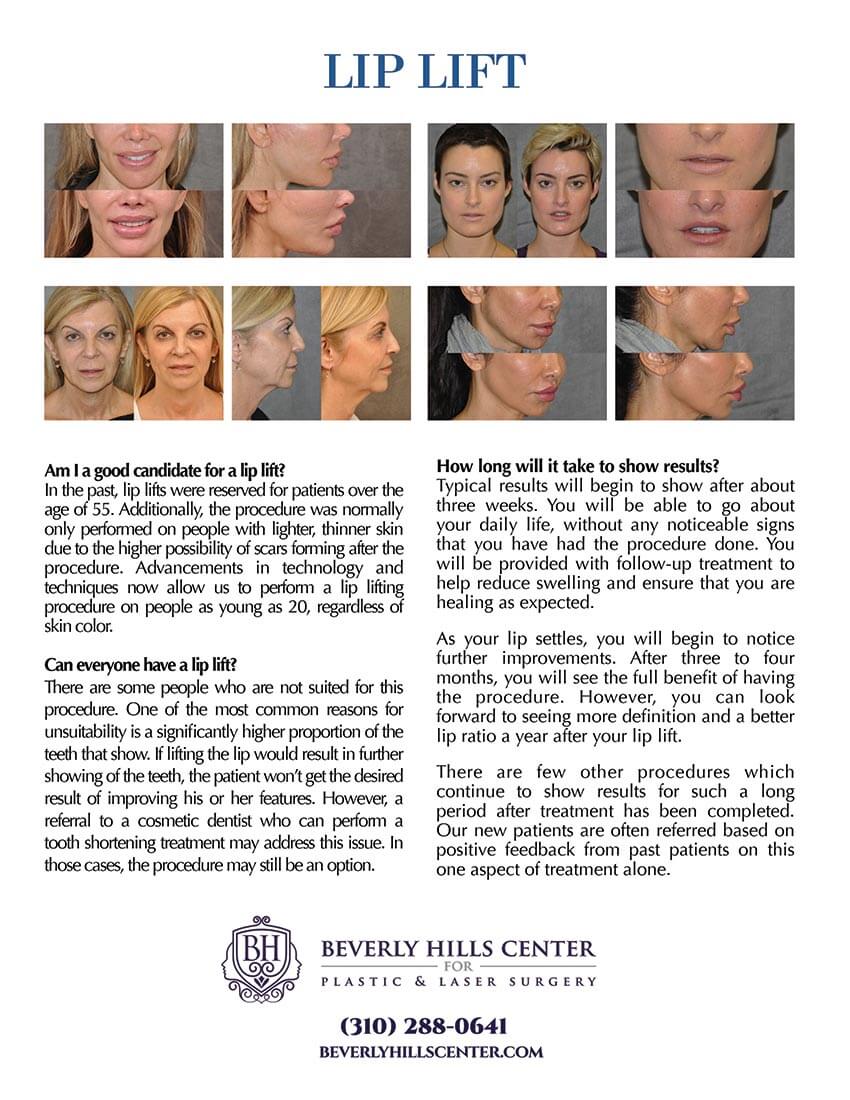 Lip Lift