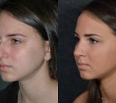 Teenage Girl Before and After Rhinoplasty, Beverly Hills CA