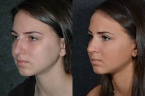 Teenage Girl Before and After Rhinoplasty, Beverly Hills CA