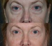 Eyelid Lift Doctor in Beverly Hills CA