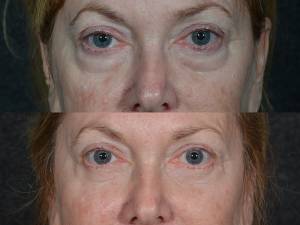 Eyelid Lift Doctor in Beverly Hills CA