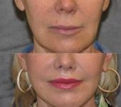 Beverly Hills CA Plastic Surgeon for Lip Enhancement