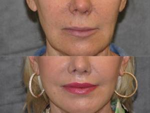 Beverly Hills CA Plastic Surgeon for Lip Enhancement