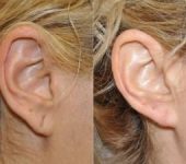 Beverly Hills CA Earlobe Repair Surgeon