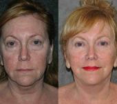 woman before and after Facelift Surgery in Beverly Hills CA