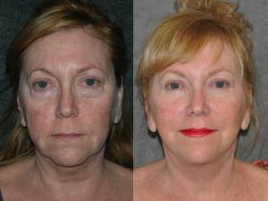 woman before and after Facelift Surgery in Beverly Hills CA