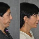 woman before and after Chemical Facial Peel in Beverly Hills CA