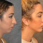 woman before and after Chin Implant surgery in Beverly Hills CA