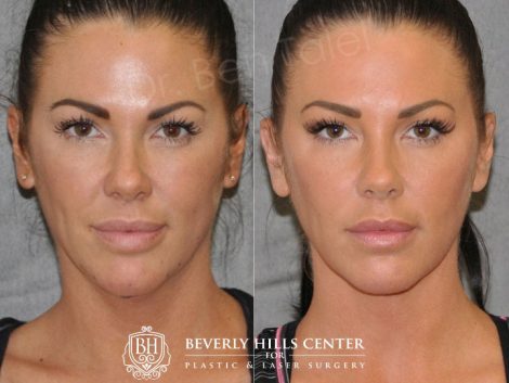 Cheek Enhancement & Neck MicroLiposuction - Front