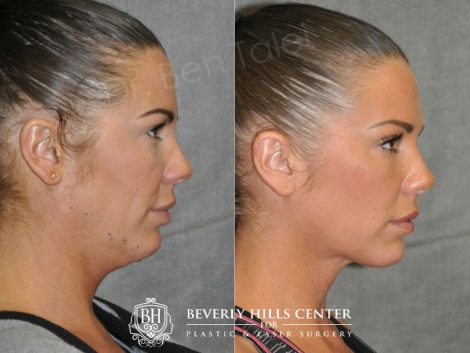 Cheek Enhancement & Neck MicroLiposuction - Right Side