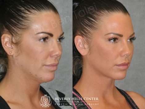 Cheek Enhancement & Neck MicroLiposuction - Right Side