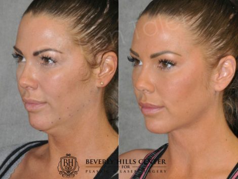 Cheek Enhancement & Neck MicroLiposuction - Left Side