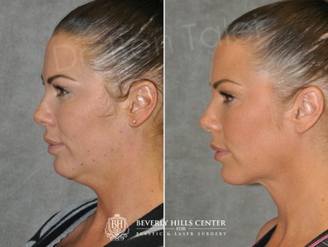 Cheek Enhancement & Neck MicroLiposuction - Left Side