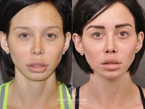Modified Upper Lip Lift - Front