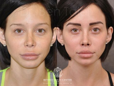 Modified Upper Lip Lift - Front