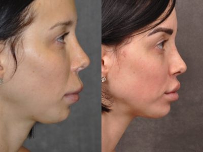 Modified Upper Lip Lift - Right Side