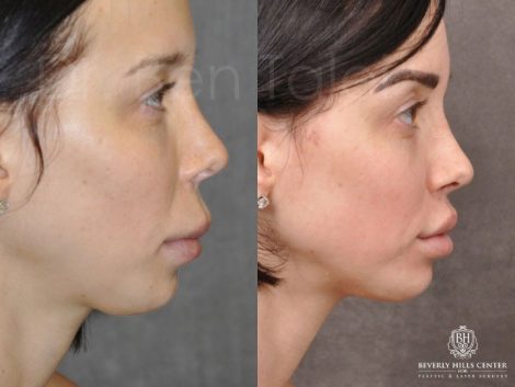 Modified Upper Lip Lift - Right Side
