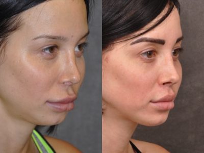 Modified Upper Lip Lift - Right Side
