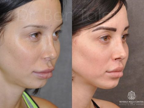 Modified Upper Lip Lift - Right Side