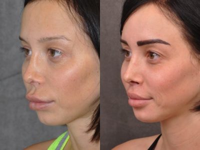 Modified Upper Lip Lift - Left Side