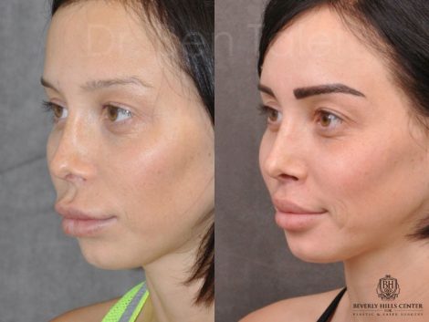 Modified Upper Lip Lift - Left Side