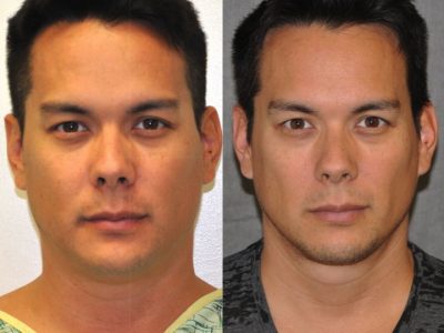 MicroLiposuction of the Neck and Chin – Front