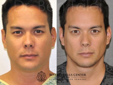 MicroLiposuction of the Neck and Chin – Front