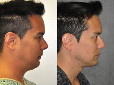 MicroLiposuction of the Neck and Chin – Right Side