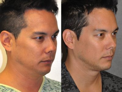 MicroLiposuction of the Neck and Chin – Right Side