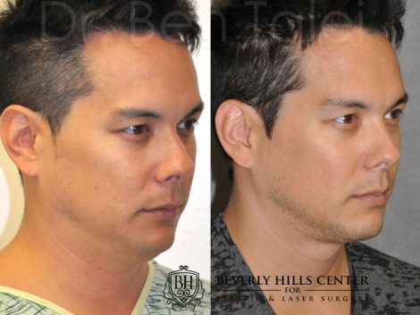 MicroLiposuction of the Neck and Chin – Right Side