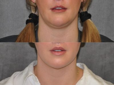 Neck and Chin MicroLiposuction - Front