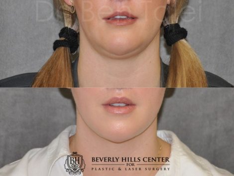 Neck and Chin MicroLiposuction - Front