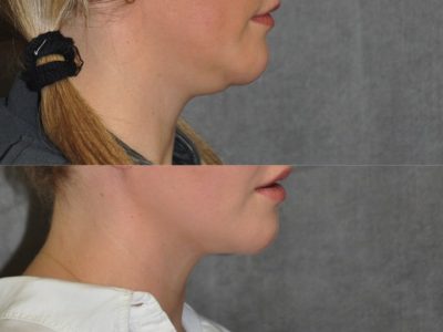 Neck and Chin MicroLiposuction - Right Side