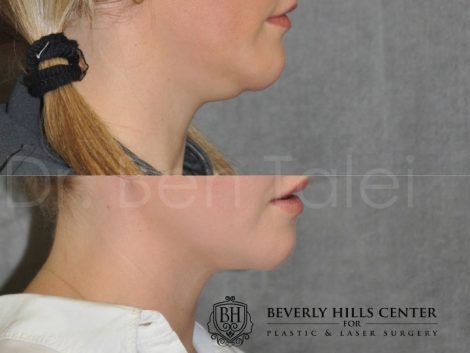Neck and Chin MicroLiposuction - Right Side