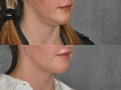 Neck and Chin MicroLiposuction - Right Side