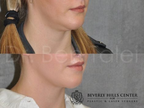 Neck and Chin MicroLiposuction - Right Side