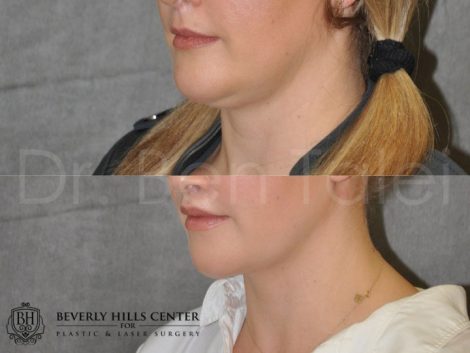 Neck and Chin MicroLiposuction - Left Side