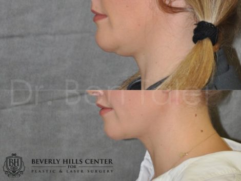 Neck and Chin MicroLiposuction - Left Side
