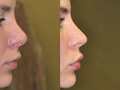 Non Surgical Rhinoplasty / Liquid Nosejob
