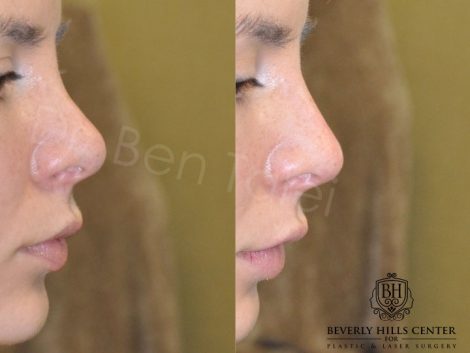 Non Surgical Rhinoplasty / Liquid Nosejob