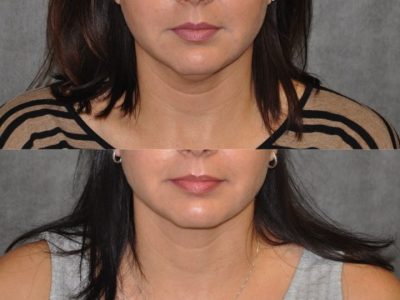 MicroLiposuction of the Neck and Chin - Front
