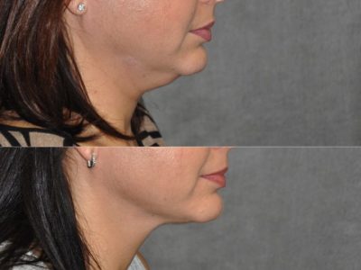 MicroLiposuction of the Neck and Chin - Right Side