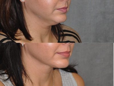 MicroLiposuction of the Neck and Chin - Right Side