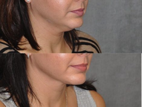 MicroLiposuction of the Neck and Chin - Right Side