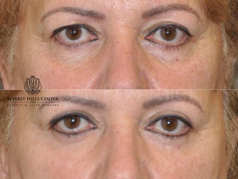 Upper Eyelid Lift - Front