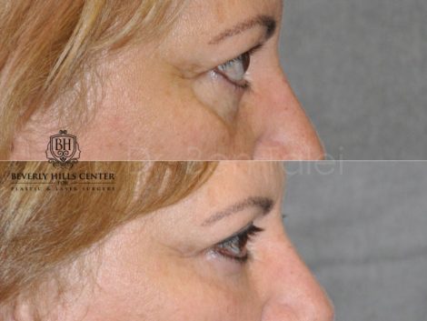 Upper Eyelid Lift - Right Side