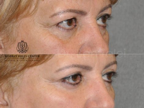 Upper Eyelid Lift - Right Side