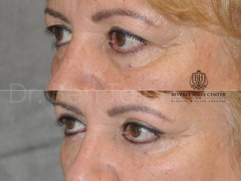 Upper Eyelid Lift - Left Side