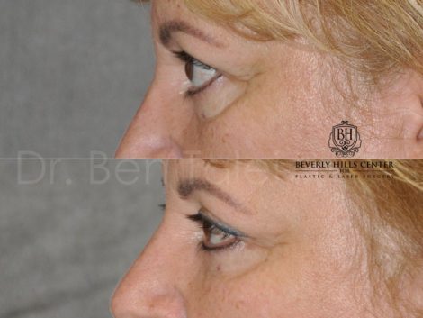 Upper Eyelid Lift - Left Side