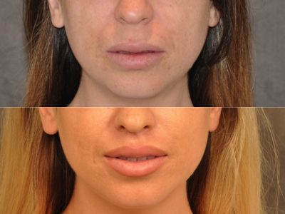 Modified Upper Lip Lift – Front